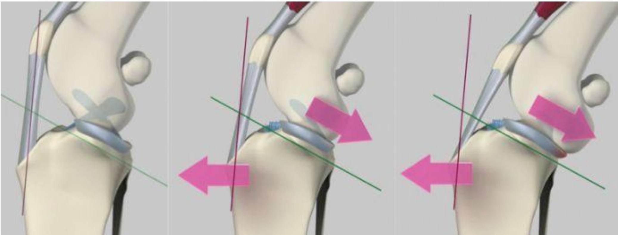 TPLO - Mechanics of cranial cruciate ligament instability